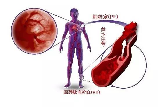 认识一下深静脉血栓,认识血栓