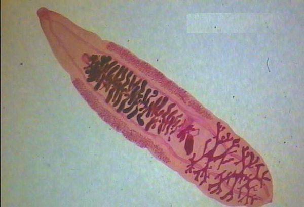 胆囊里面有虫怎么办,胆囊有虫什么症状