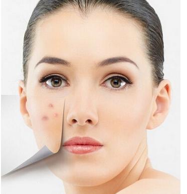 痘痘困扰做好这几点就能解决它,痘痘问题一直都是困扰