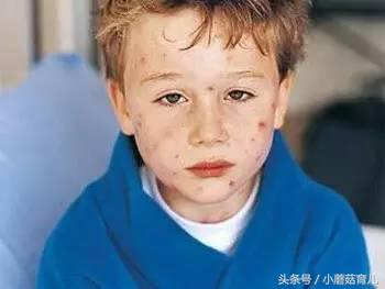 水痘有可能突然好了么,水痘高发易中招