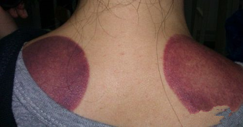 怎么通过拔罐的颜色判断身体状况,肩膀拔罐后颜色黑紫是怎么回事