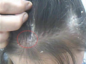 头皮发黄、发红、头屑多、脱发？这是头皮的求救信号！