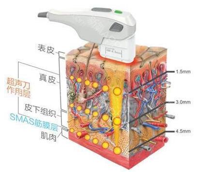 超声刀的基本知识,超声刀基础知识