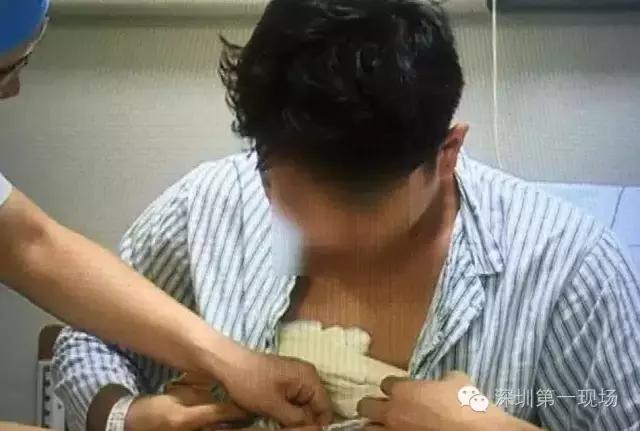 25岁小伙胸不断“发育”如鸡蛋大