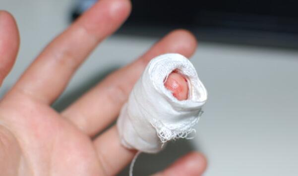 正确处理伤口避免破伤风,伤口感染破伤风最佳处理方法