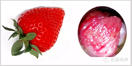 有趣痔疮的知识讲解,怪异的痔疮