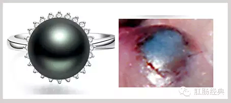 有趣痔疮的知识讲解,怪异的痔疮