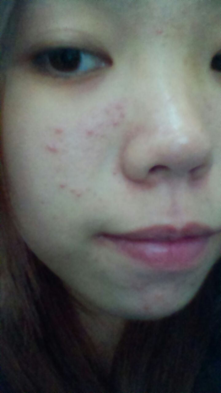 脸颊左侧和下巴长痘痘是什么原因,男生下巴脸颊长痘痘是什么原因