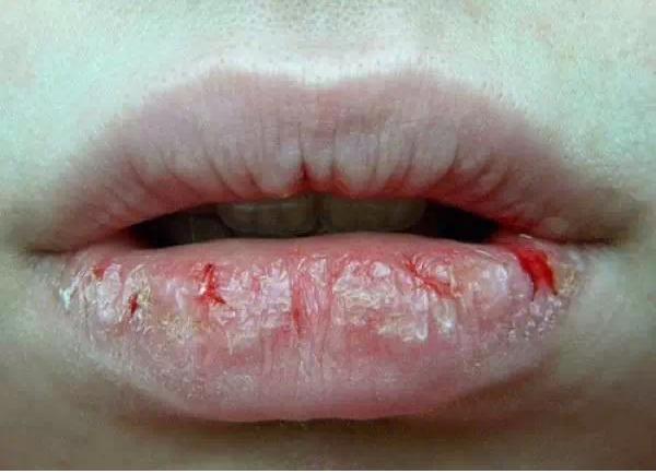 冬天脚后跟干裂口子怎么治小妙招,冬天嘴巴容易干裂脱皮是什么原因