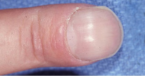 指甲的变化意味着身体的健康状况,当指甲发绿发脓的时候要怎么处理