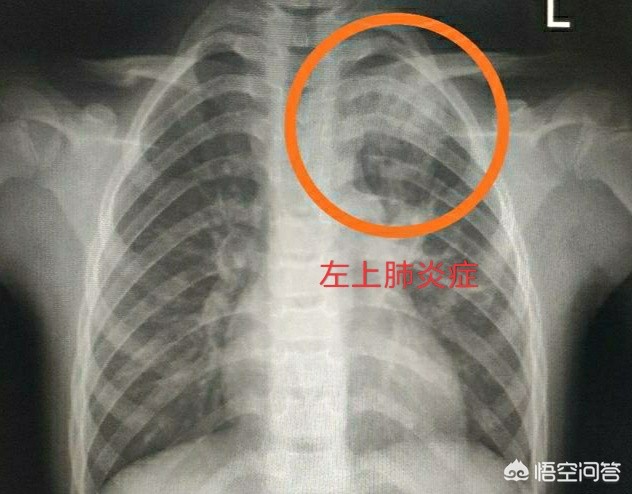 孩子得了肺炎一定要输液吗？医生：请避开这9个认知误区