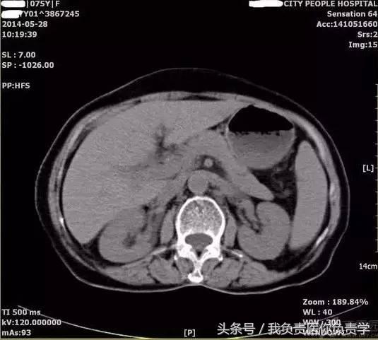 楂樻墜杩涢樁鑵拌吂璁粌,鑳嗗泭缁撶煶绌垮瓟鐥囩姸