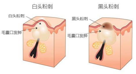 鼻子长黑头了4步骤安全去黑头,鼻子黑头如何洗掉小窍门