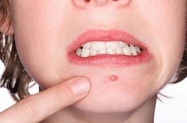 后背起包后挤出脓液怎么回事,后背老长疙瘩怎么回事