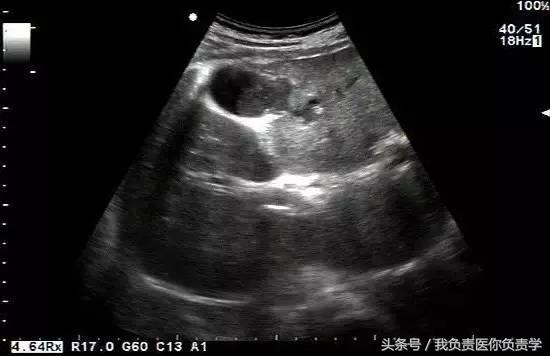 楂樻墜杩涢樁鑵拌吂璁粌,鑳嗗泭缁撶煶绌垮瓟鐥囩姸