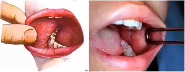 诊断麻疹最快速的方法,麻疹怎么做检测