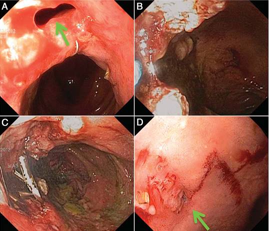 克罗恩病内镜严重程度指数,克罗恩病内镜检查是怎么样的