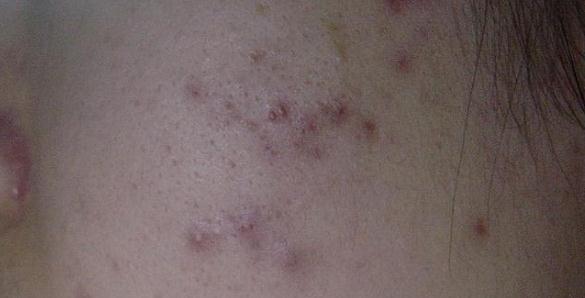 真正祛痘印有效的方法,最简单有效祛痘印的方法