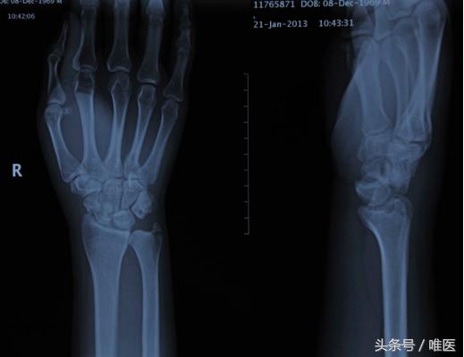 月骨舟骨半脱位手术,手腕舟骨月骨周围脱位要多久康复