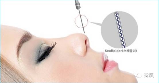 林允是不是整鼻子了,林允隆鼻过吗