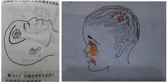 颅骨凹陷性骨折复位视频,儿童鼻骨骨折做手术是微创手术吗