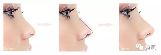 林允是不是整鼻子了,林允隆鼻过吗