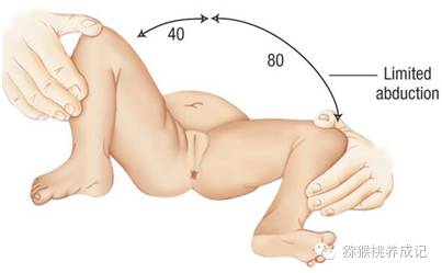 大腿纹不对称图片大全,新生儿大腿皮纹不对称怎么办