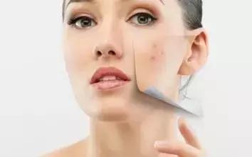 蜂蜜能治脸上的痘痘吗,脸上长痘痘涂蜂蜜可以消炎