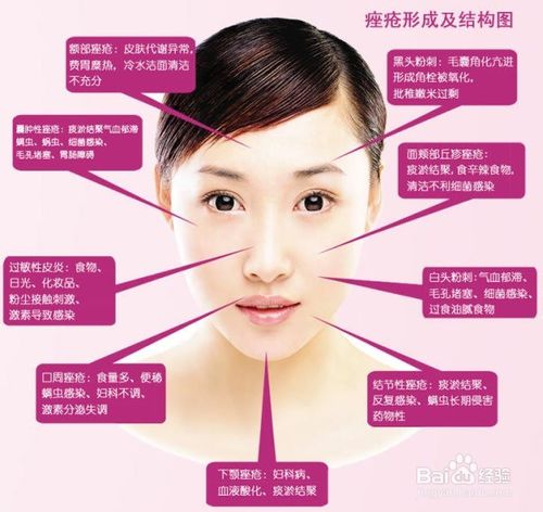 青少年青春痘的治疗小偏方,怎么抗痘痘最有效的方法