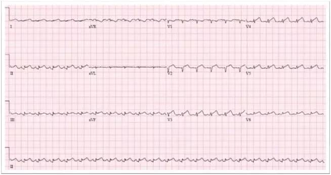 心电图st段呈j点型抬高是什么意思,心电图st段抬高一定是心梗吗