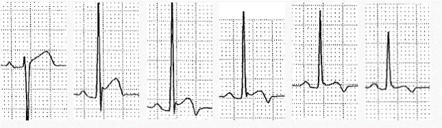 心电图st段抬高0.05mv是什么意思,心电图st段抬高但心脏彩超都正常