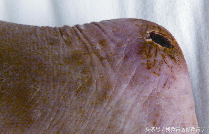 肾移植后坏死能活多久,肾移植后常见的感染部位有哪些