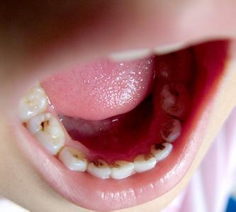 宝宝乳牙神经坏死会影响换牙吗,乳牙龋齿严重牙神经坏死