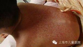 孩子高烧不退当心川崎病,孩子高烧不退当心得了川崎病