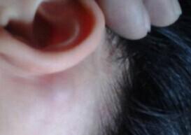 儿童川崎病持续高烧能降下来吗,孩子反复发烧出皮疹要小心川崎病