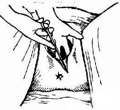 孕产名词解释｜会阴侧切，你需要了解的事