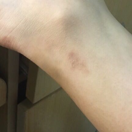 推荐一款好用祛疤膏,新增祛疤膏推荐