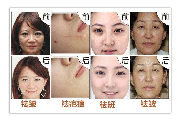 激光祛斑科普你想知道的一切,皮秒和激光哪个祛斑效果最好