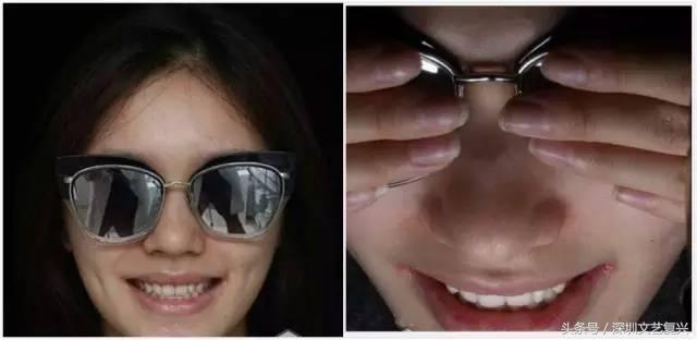 林允整牙效果怎么样,林允整牙后变化图片