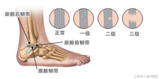 科普足踝扭伤防治,踝关节扭伤处理视频