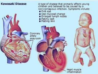 患过川崎病的宝宝感冒了,小儿发烧不咳嗽怀疑川崎病