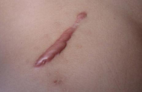 疤痕疙瘩患者不能吃橘子？