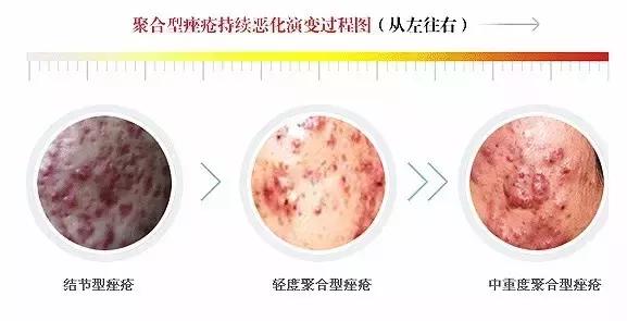 是不是有创面就会有疤痕,是不是痘痘下去了有痘坑