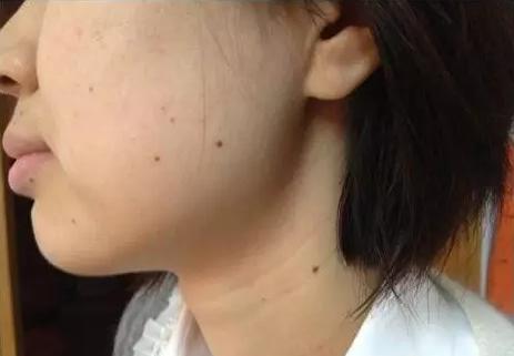 祛痣会引起黑色素瘤,点痣诱发恶性黑色素瘤