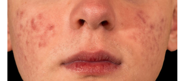 面部针清祛痘能彻底吗,针清祛痘后怎么修复