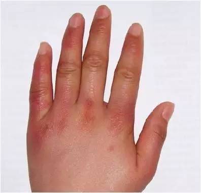 冬天长冻疮的最好方法,冬天治冻疮最好的方法