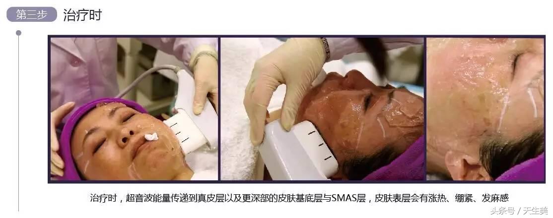 超声刀怎么样啊 (超声刀分享)