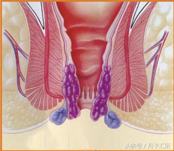 产后肛裂痔疮怎么办,便秘后肛裂了怎么办