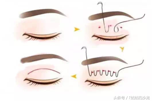 纳米无痕双眼皮的线有点红,纳米无痕双眼皮操作全过程