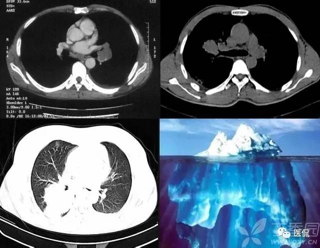 影像学呼吸系统理论知识,呼吸系统疾病影像学常见征象